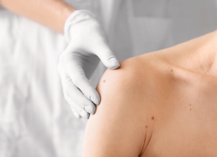 Dermatologia dla nie-dermatologów okiem praktyka